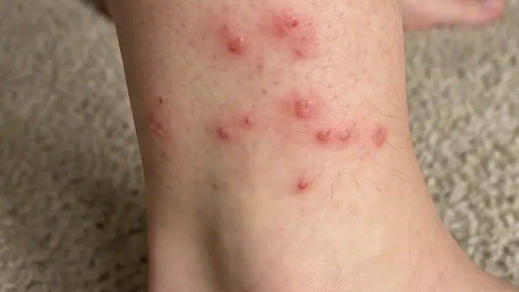 Cluster of small raised red flea bite bumps across a person's ankle and lower leg