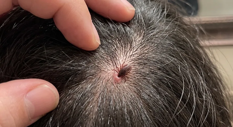 Tick attached to the scalp within the hairline, held in view by two fingers parting the hair