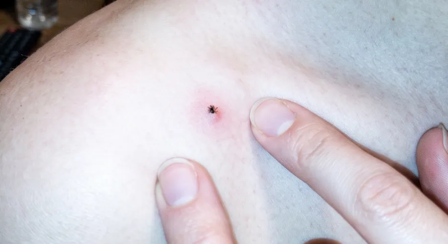Tiny dark tick attached to the skin of a shoulder, with two fingertips beside it for scale
